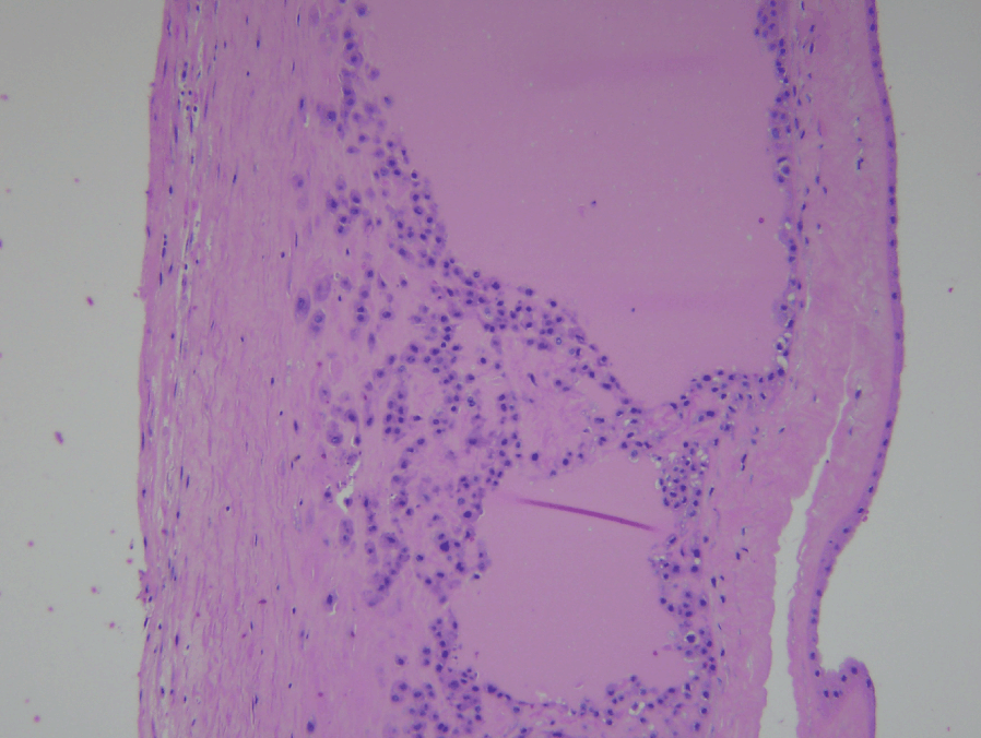 Retromembranous old looking blood clots in the placenta.