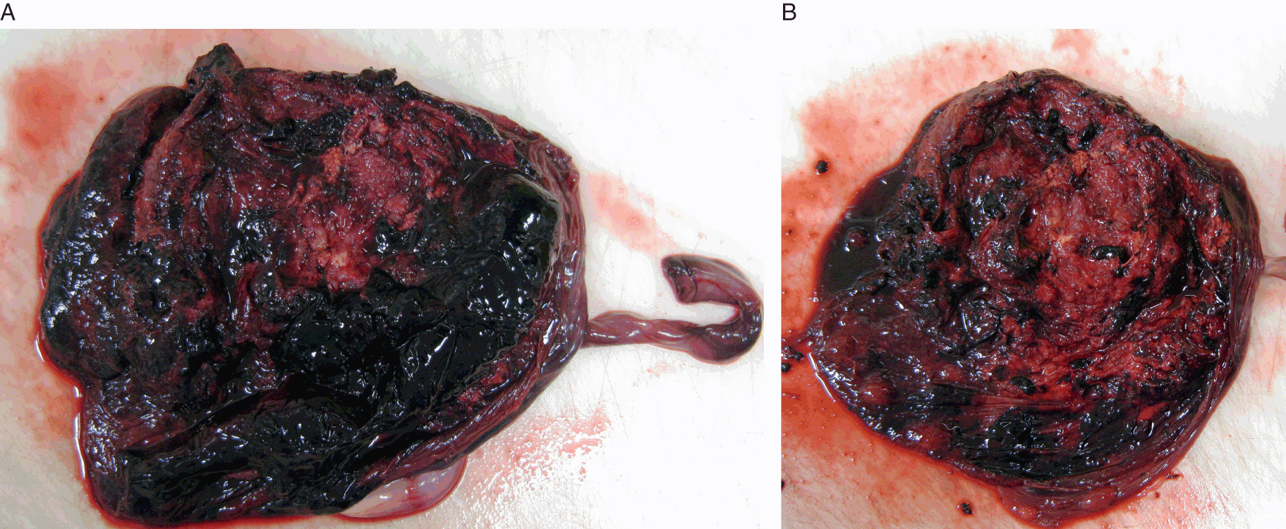 Retromembranous old looking blood clots in the placenta