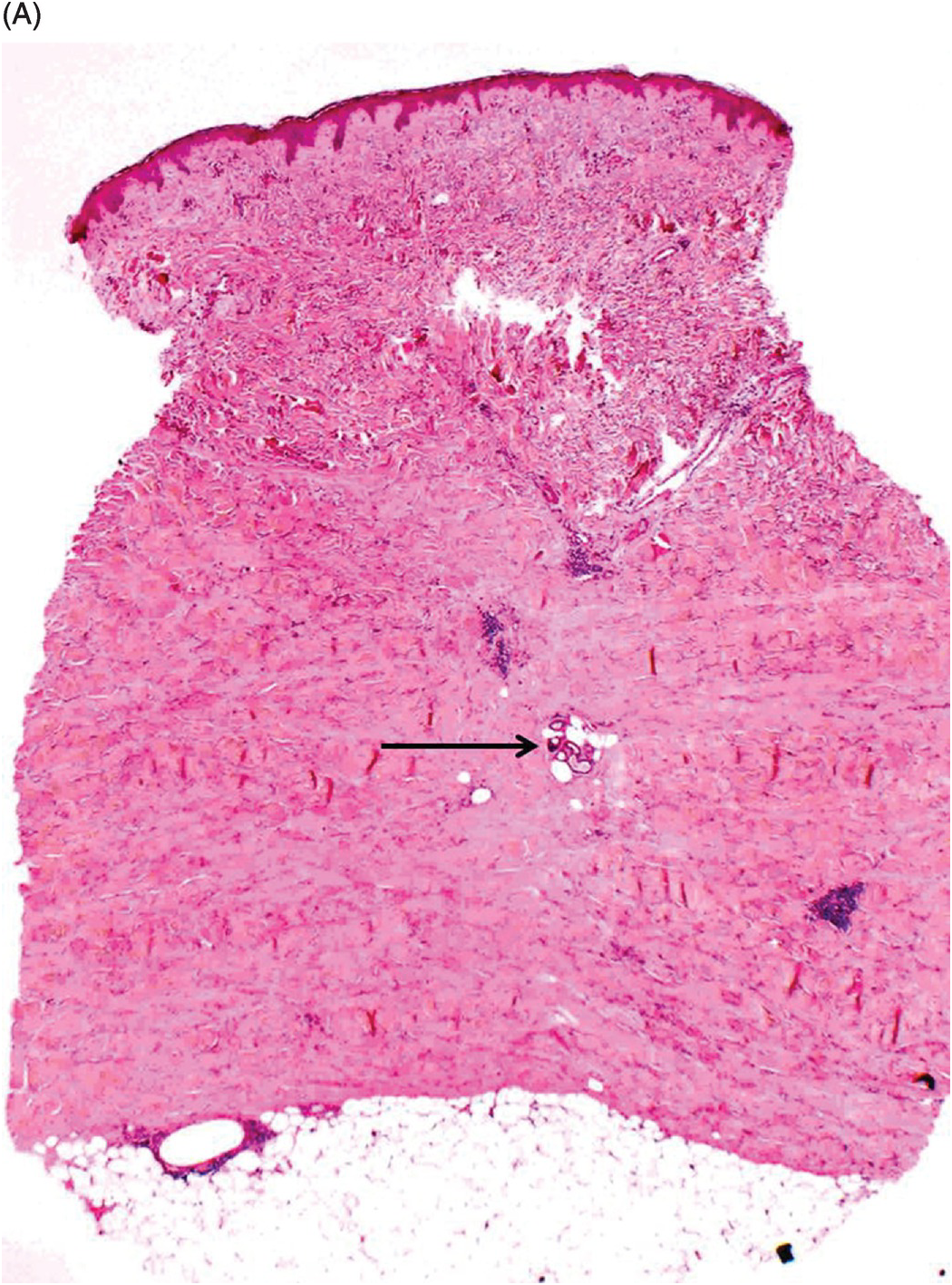 morphea histopathology