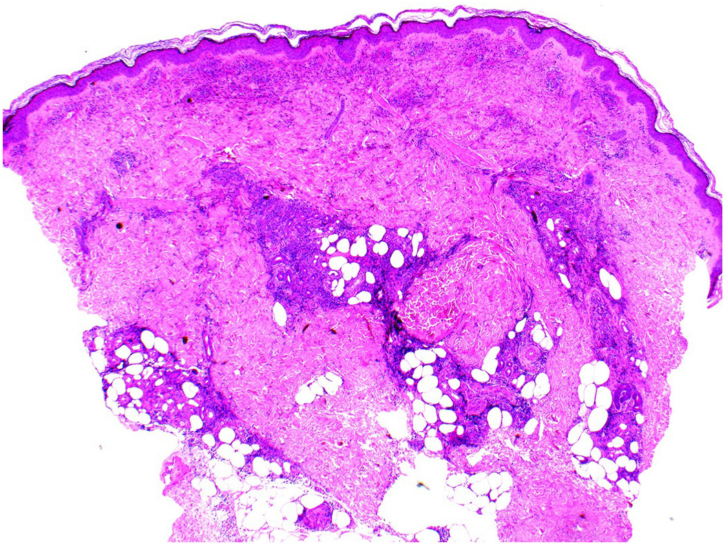vasculitis hialinizante