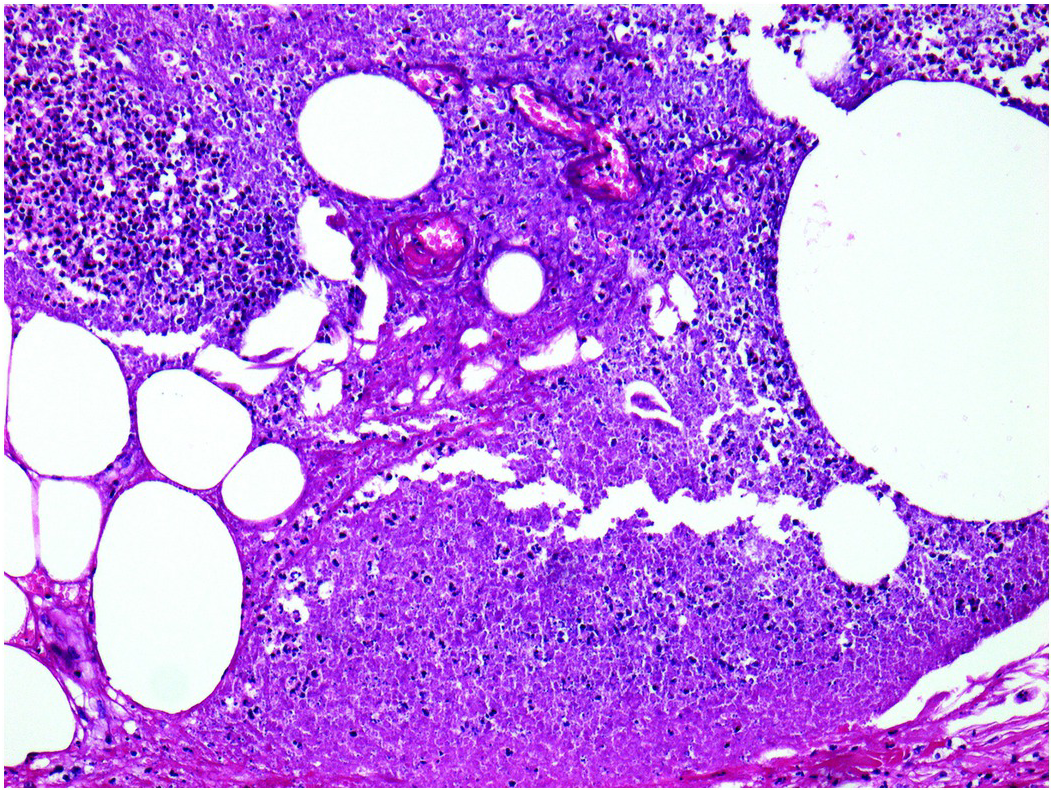 Erythema Induratum Histopathology