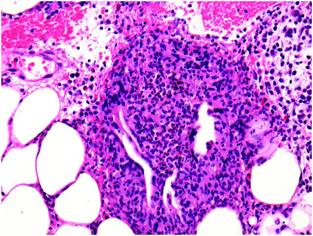 erythema nodosum histology