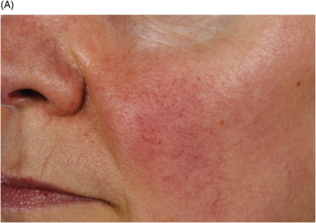 Folliculitis Forehead