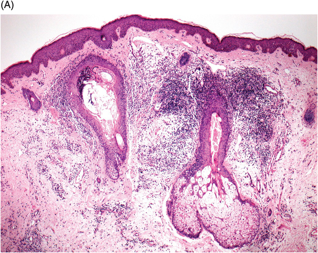 eosinophilic pustular folliculitis histology