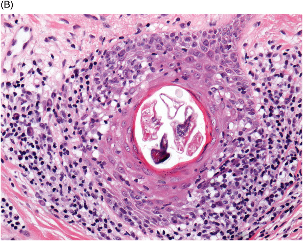 Eosinophilic Pustular Folliculitis Histology