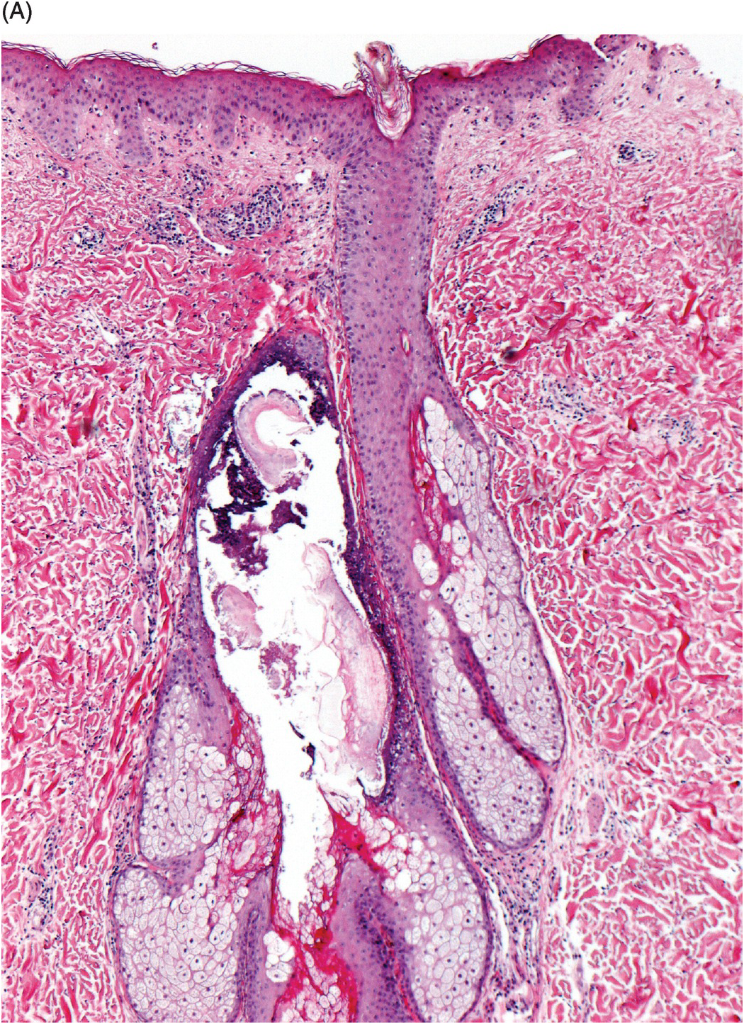 tufted folliculitis histology
