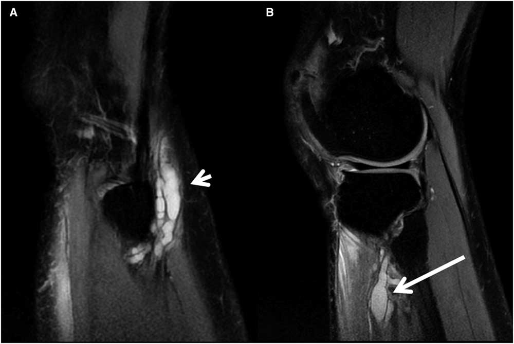 A rapidly progressive foot drop caused by the posttraumatic Intraneural  ganglion cyst of the deep peroneal nerve, BMC Musculoskeletal Disorders