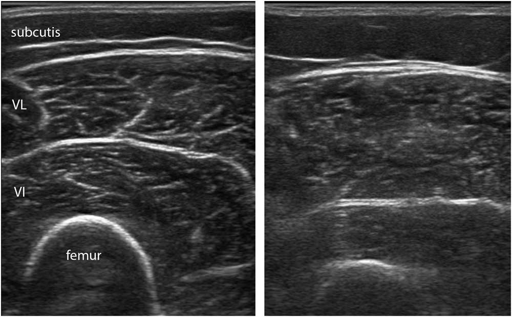 Neuromuscular Ultrasound A New Tool In Your Toolbox Canadian Journal Of Neurological Sciences 0075