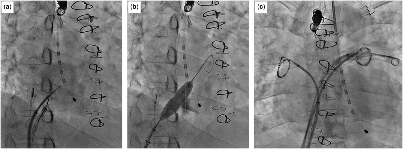 Static Balloon Atrial Septostomy For The Purpose Of Left Heart