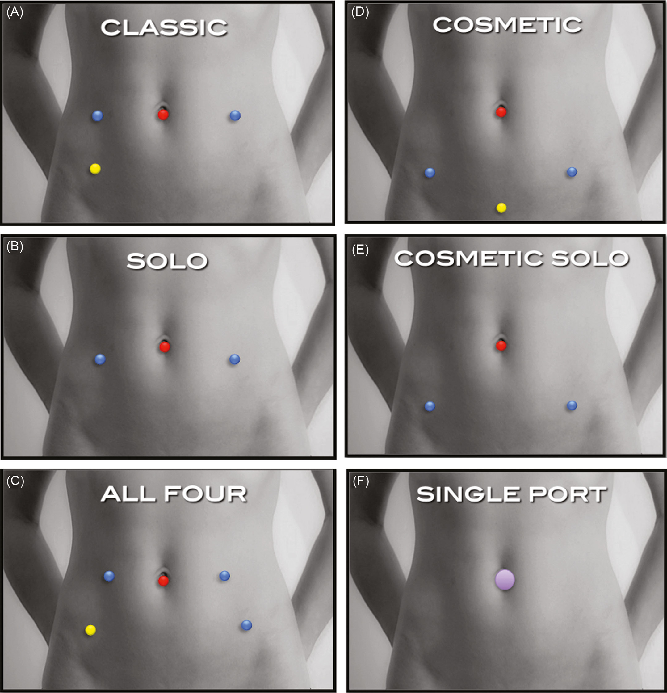 laparoscopic myomectomy scars