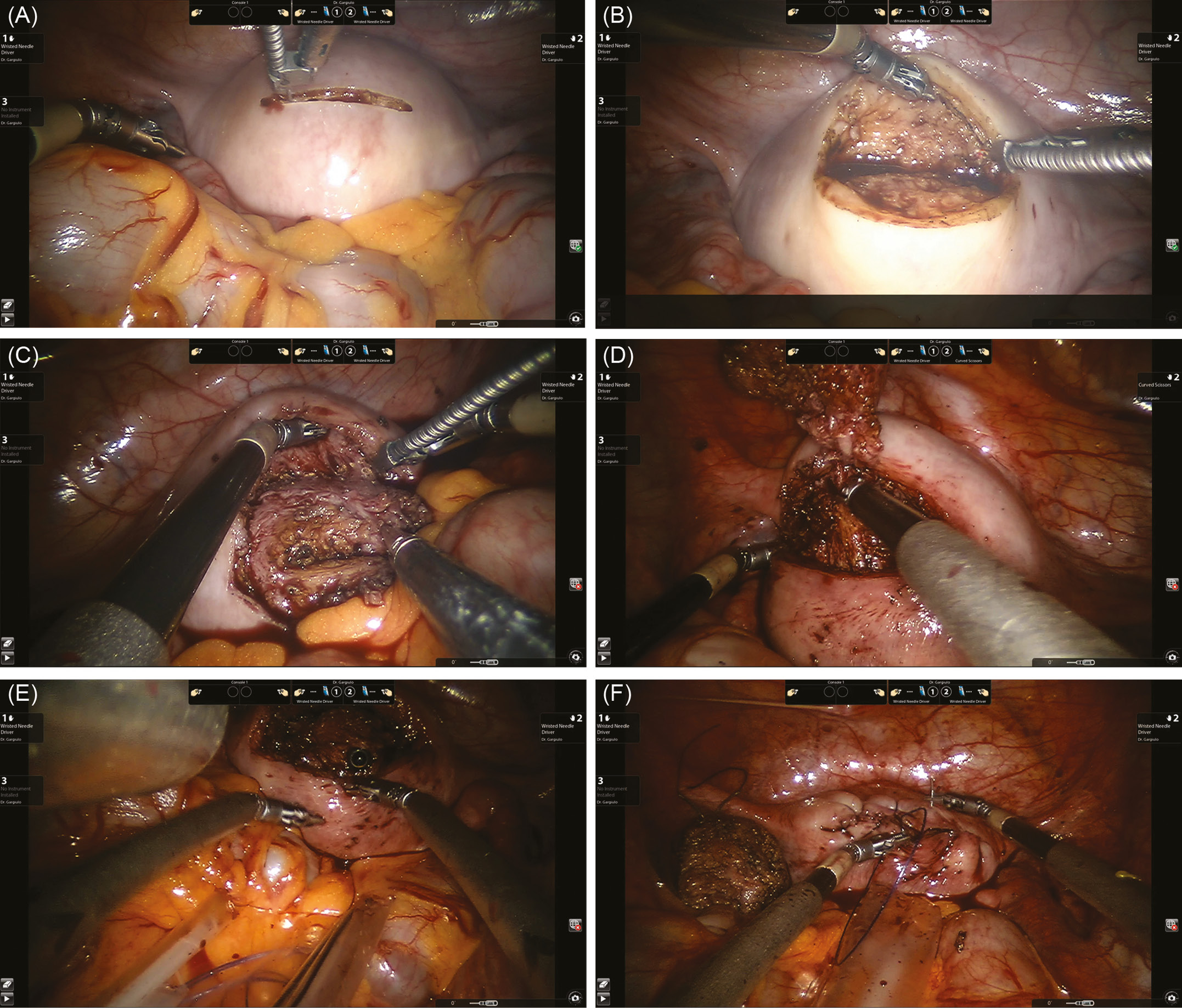 Robotic single-site myomectomy: initial report and technique