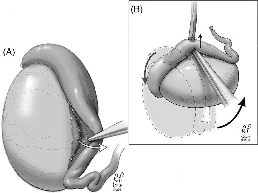 Vasectomy: An Update