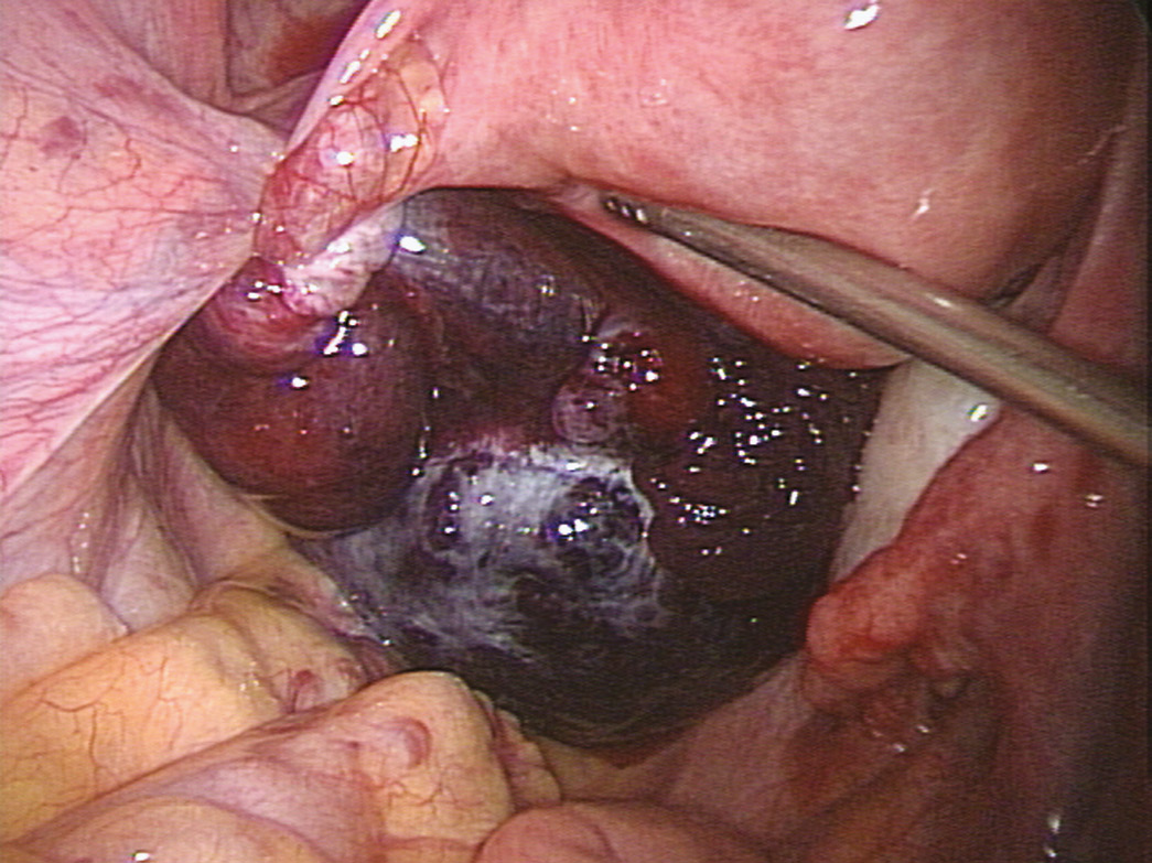 Ovarian Surgery with a Focus on Reproduction (Chapter 4) - Reproductive  Surgery, image size:1045x783