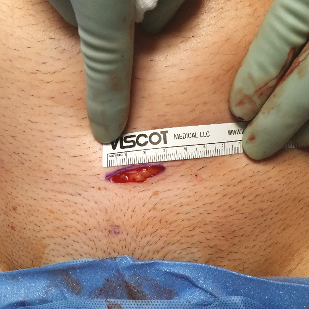 laparoscopic myomectomy scars