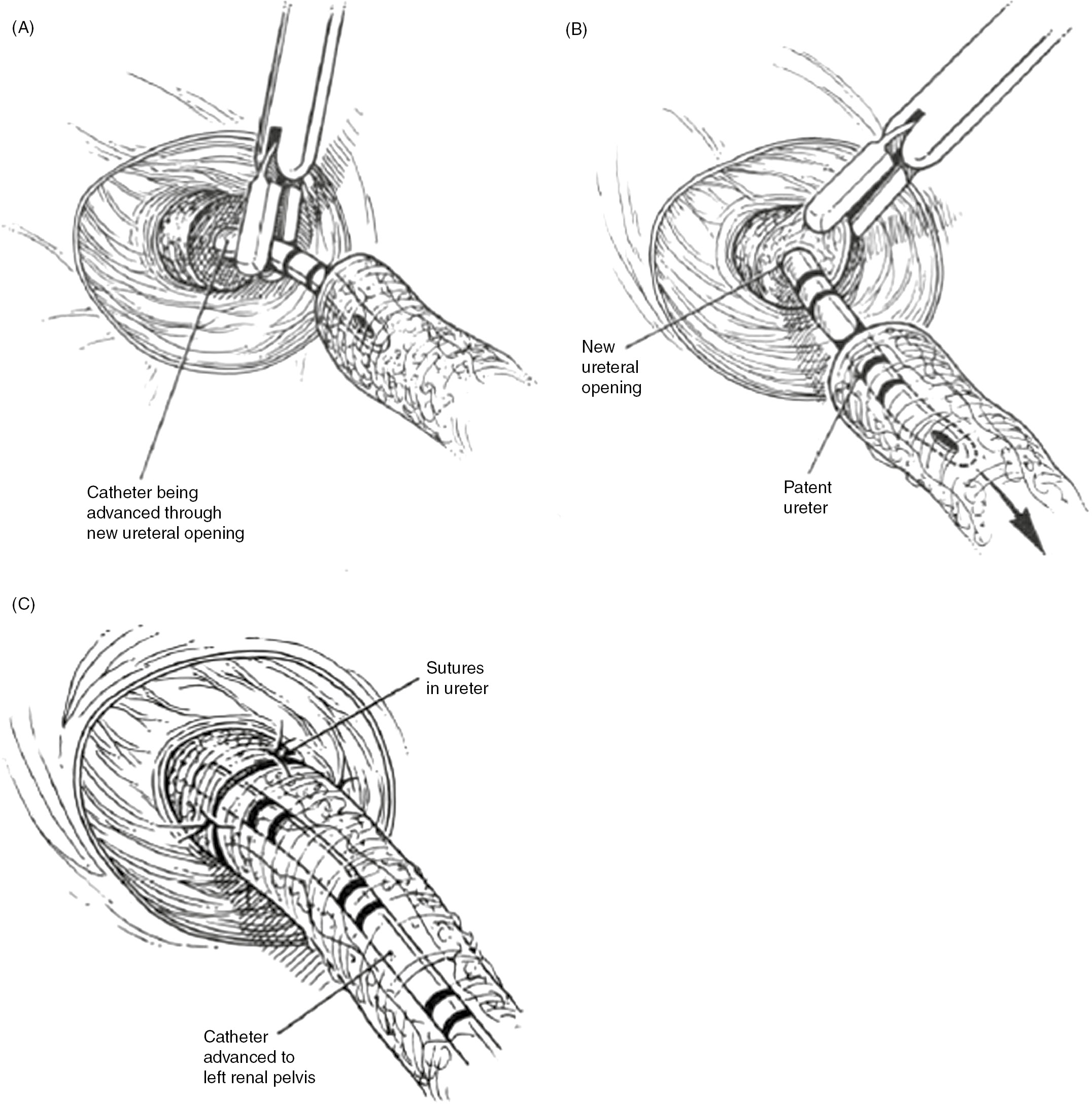 Manual of operative surgery. into the lumen of the gut by apurse-string  suture as in appendectomy.Leave uncut the suture attached to the  uppersegment of gut; apply a hemostat to the endof