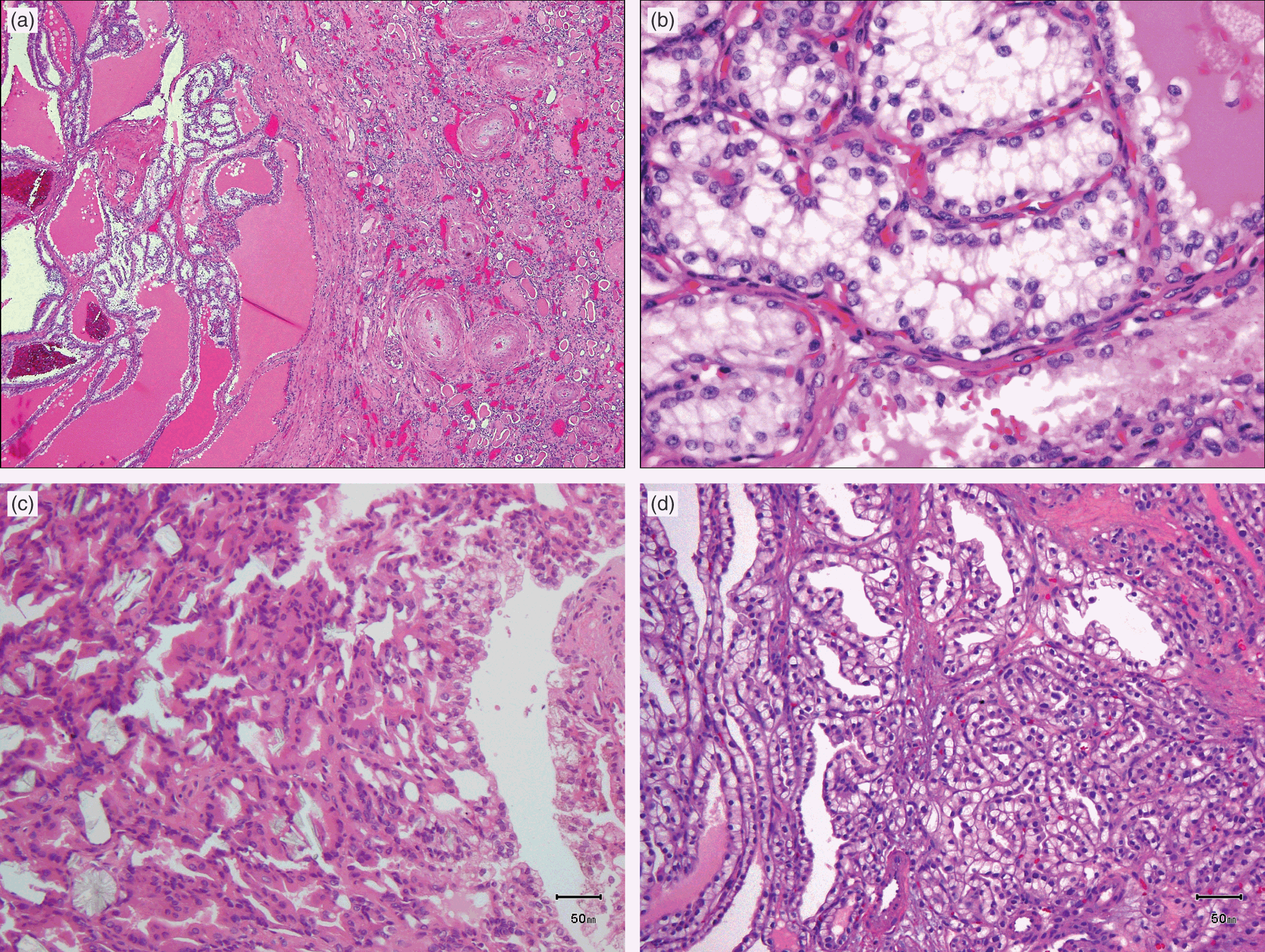 The Aging Kidney and End-stage Renal Disease (Chapter 15) - Silva's  Diagnostic Renal Pathology, image size:2080x1566