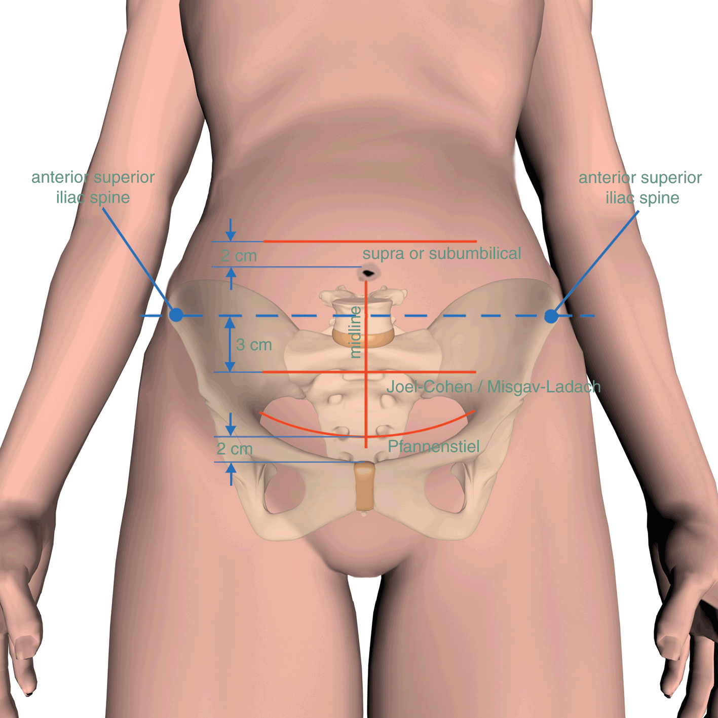transverse presentation cesarean section