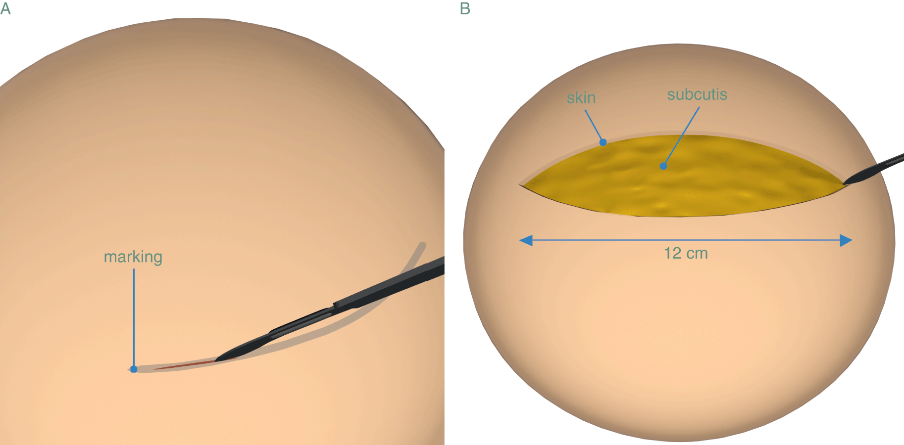 cesarean section technique with diagram