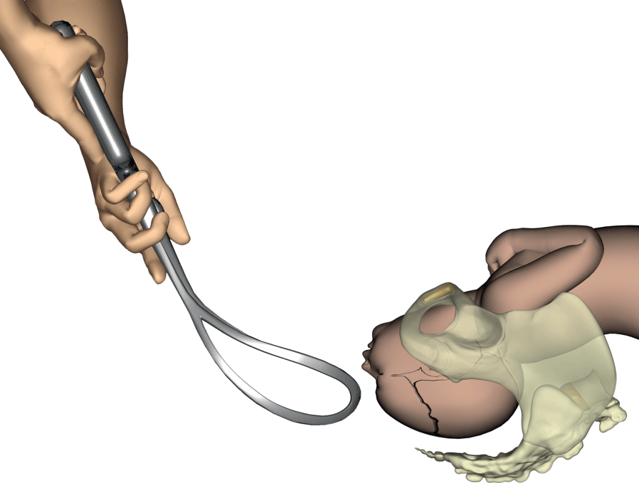 Operative Vaginal Delivery (Vacuum and Forceps Extraction) (Chapter 7) -  Obstetric Interventions