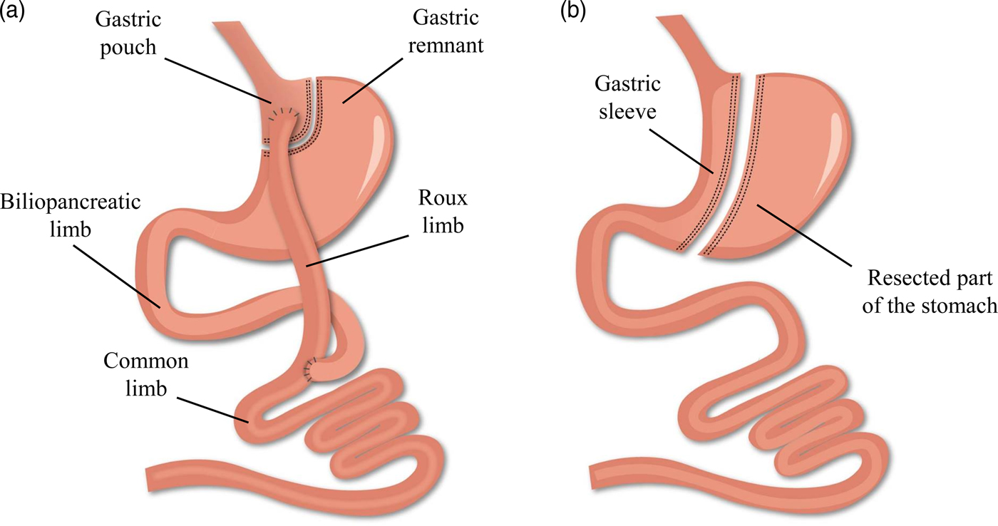 Iron deficiency after bariatric surgery: what is the real problem ...