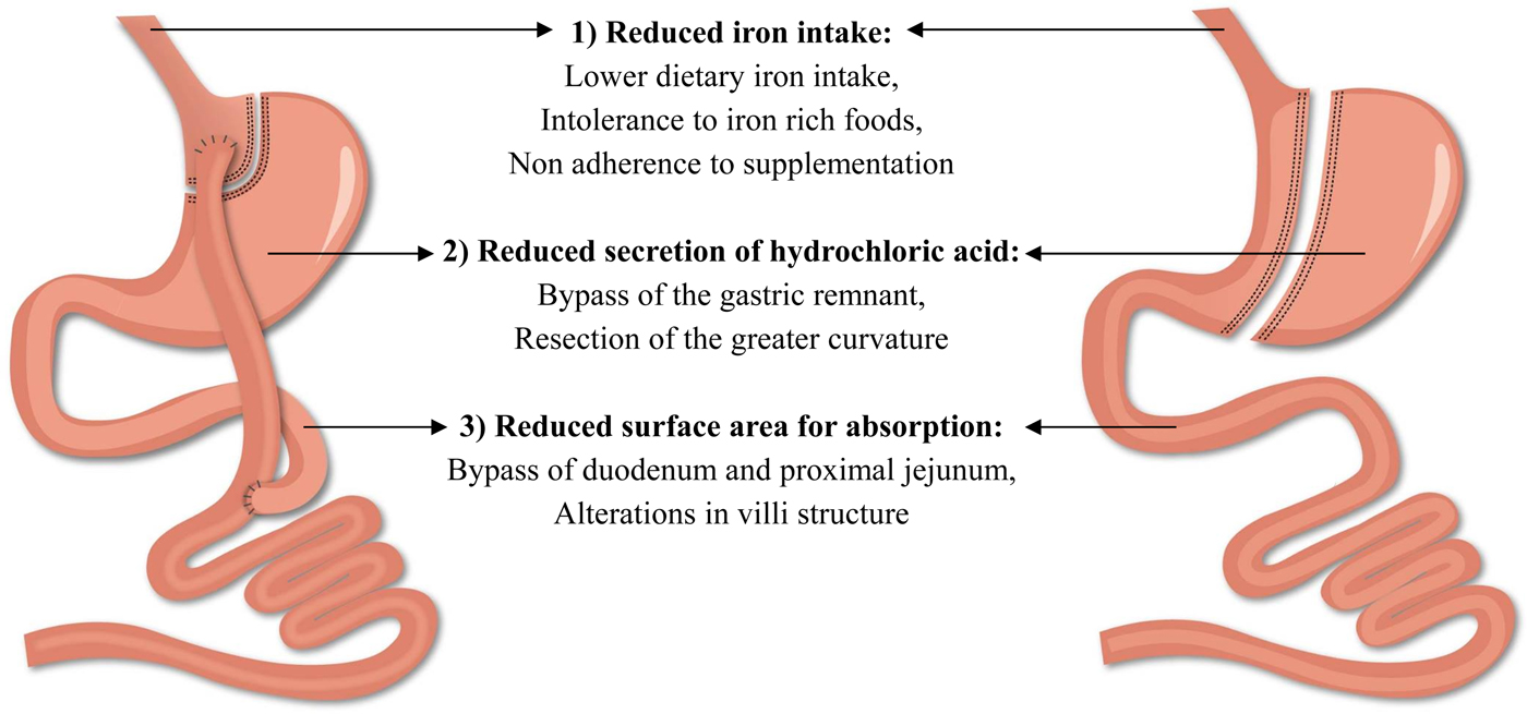 Iron deficiency after bariatric surgery what is the real problem