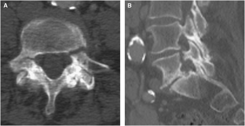 Spontaneous Atraumatic Bilateral Pedicle Insufficiency Fractures ...