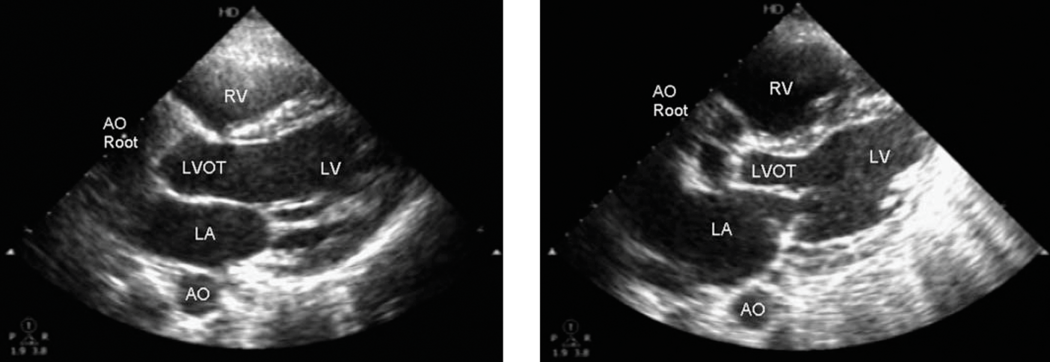 Intern Ultrasound of the Month: POCUS & Regional Wall Motion Abnormalities  — University Hospitals Emergency Medicine Residency