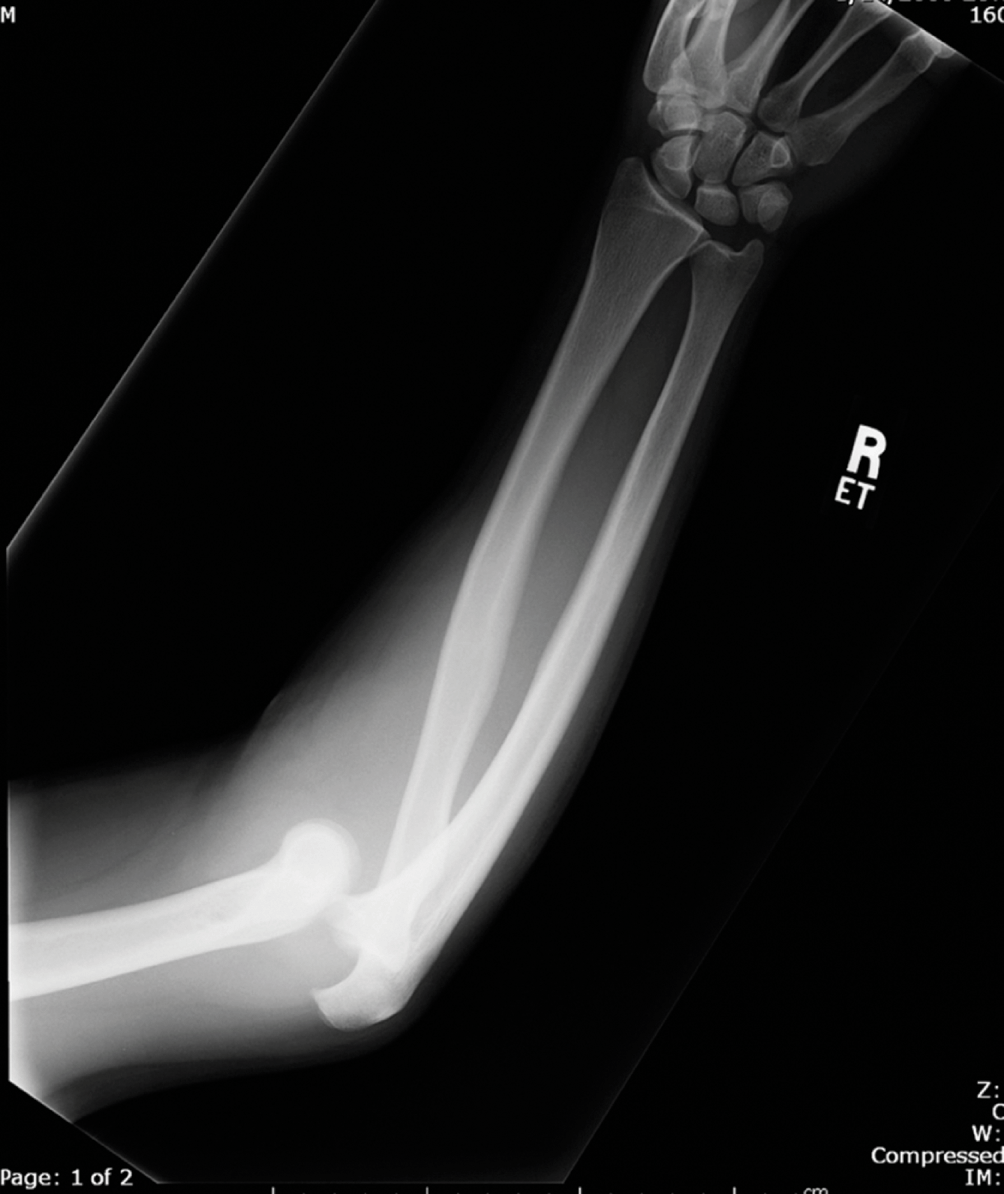 Plain Radiography of the Upper Extremity in Adults (Chapter 1