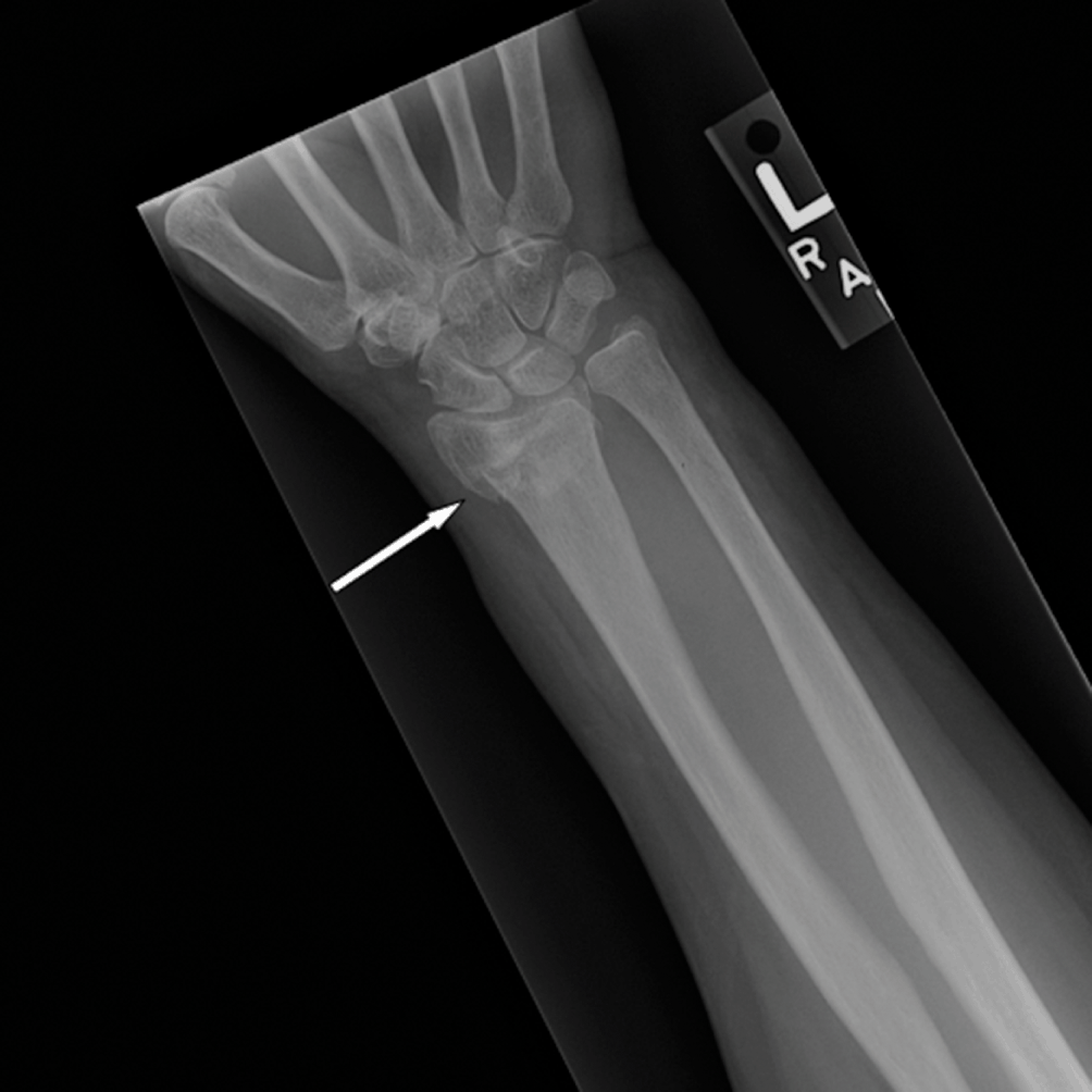 Radiographs Of The Upper Limb