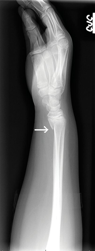 Radiographs Of The Upper Limb
