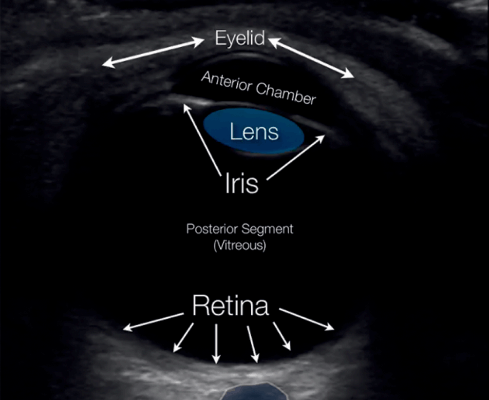 Eye Ultrasound