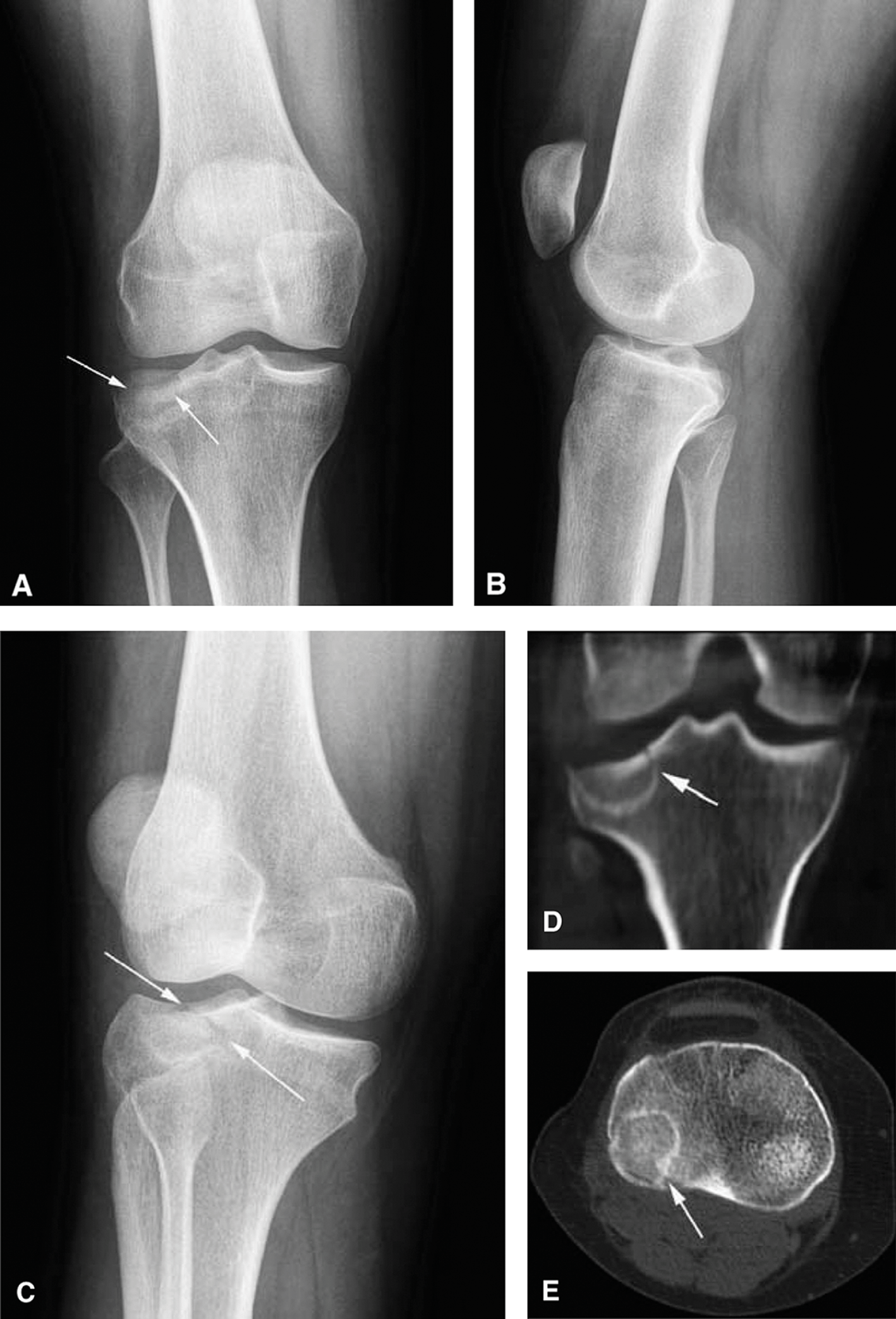 Medial tibial plateau stress fracture radiology