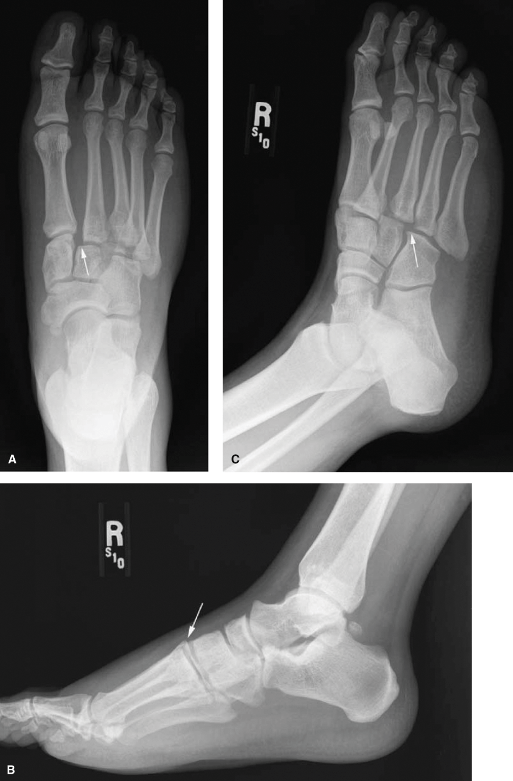 Cureus | Ilizarov-Assisted Healing for a Neglected Non-united Fracture  Calcaneus: A Case Report and Literature Review | Article