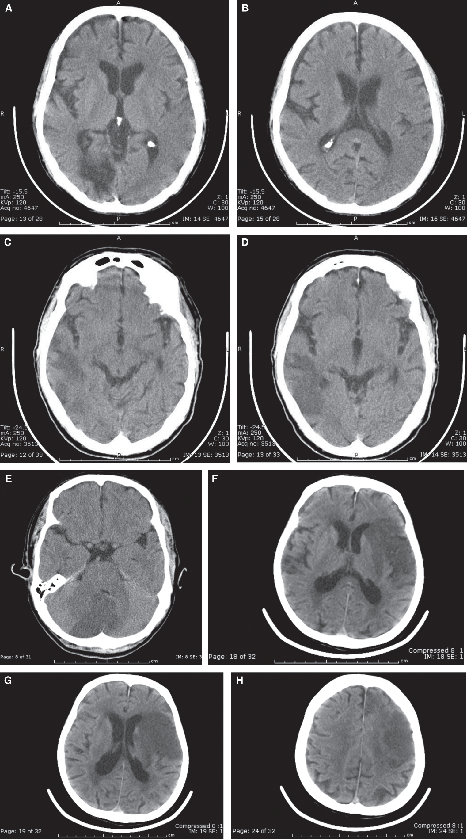 CT Imaging of the Head (Chapter 30) - Clinical Emergency Radiology