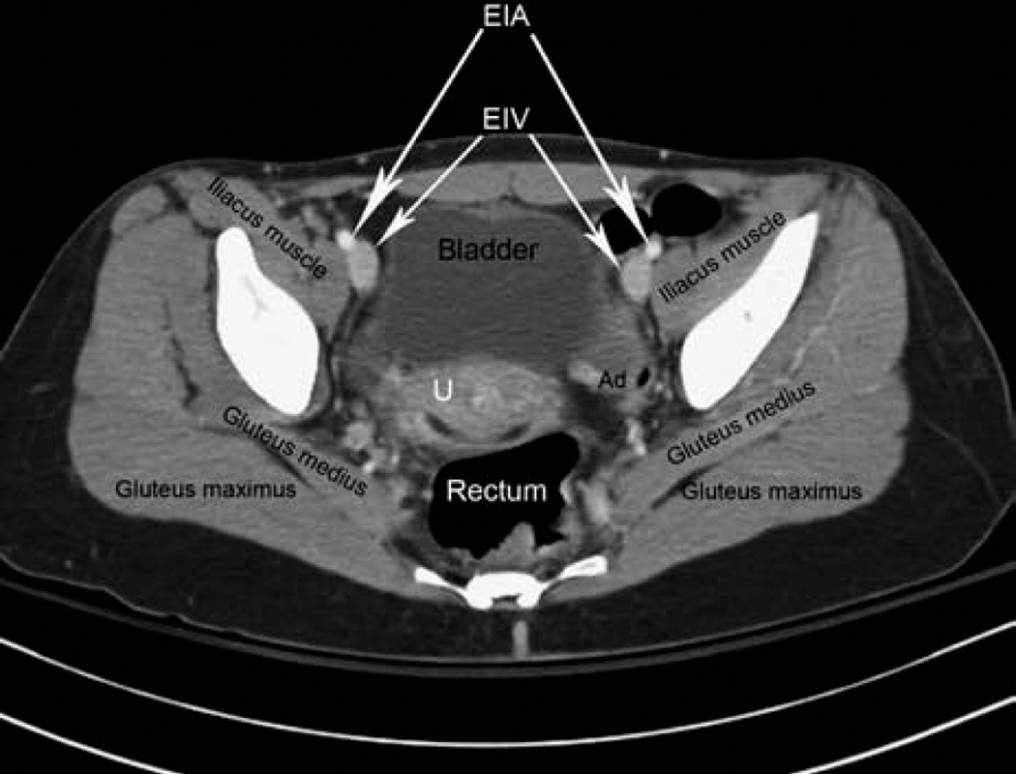 Abdominal Pelvic CT Scan