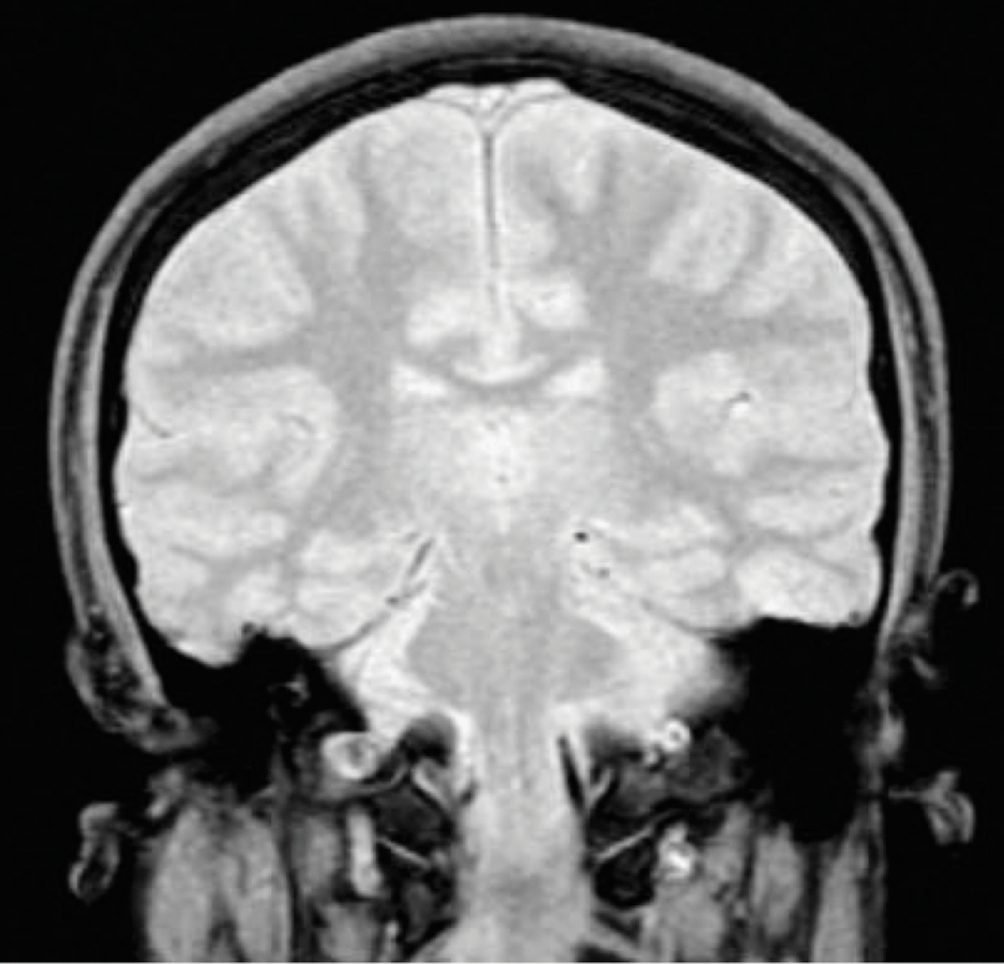 Typical magnetic resonance imaging scan showing the coracohumeral