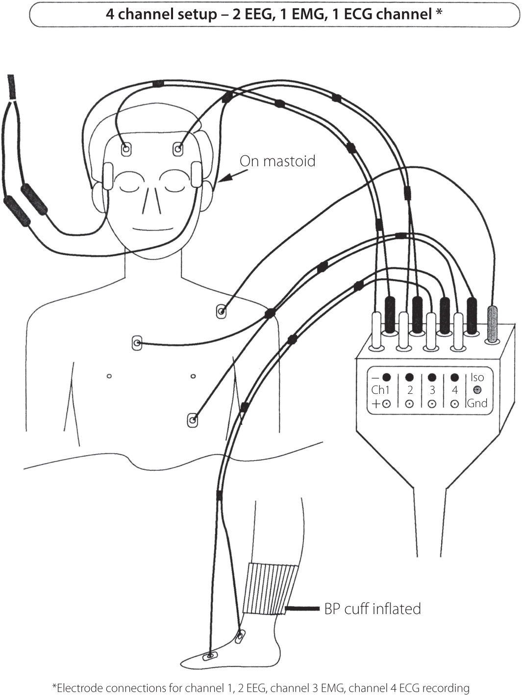 Emg Electrode Placement Chart