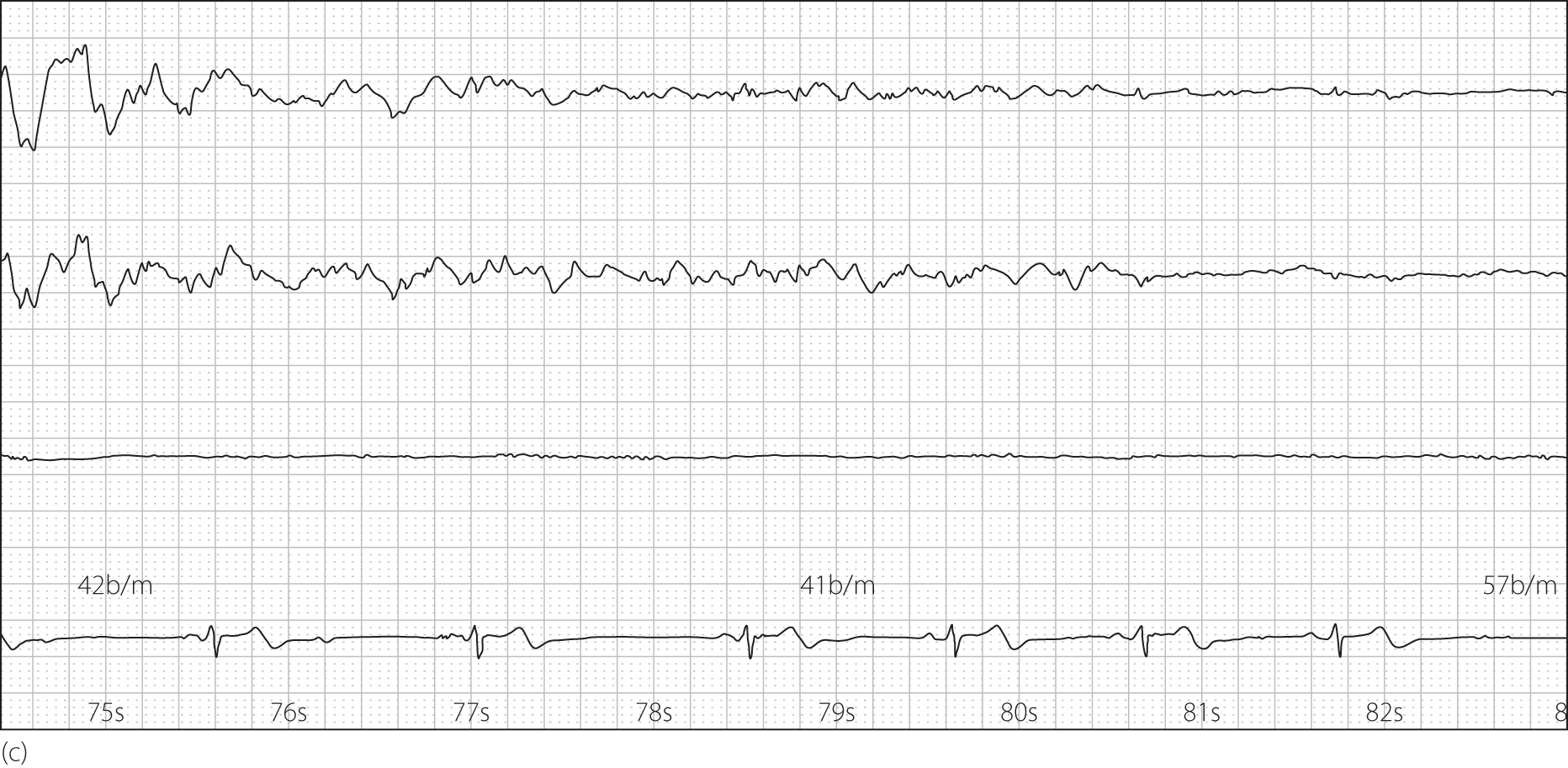 Seizure Charting Example