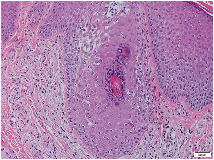 demodex folliculorum histopathology