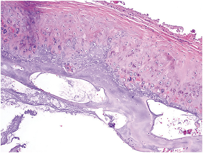 Disorders Involving The Dermis And Or Subcutis E Self