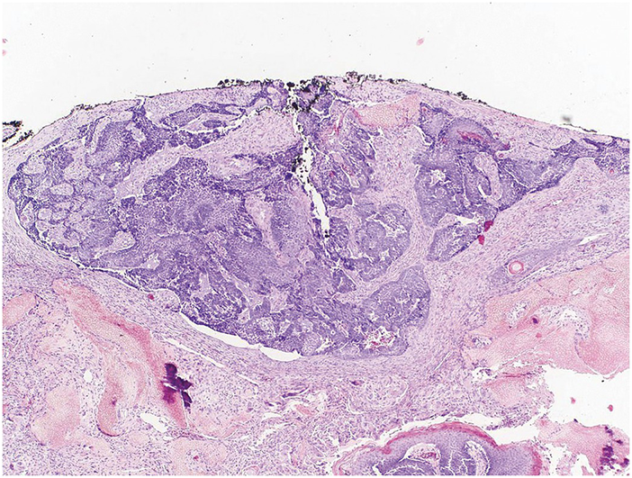 Disorders Involving The Dermis And Or Subcutis E Self