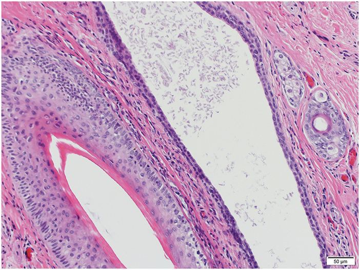 Disorders Involving The Dermis And Or Subcutis E Self