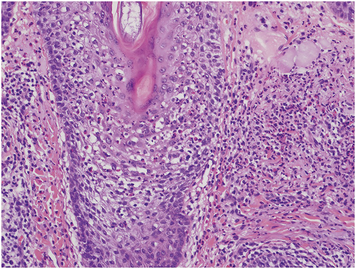 Disorders Involving The Dermis And Or Subcutis E Self