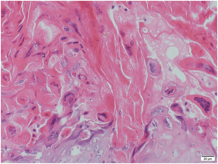 Tinea Barbae due to Trichophyton mentagrophytes Contracted from Calves, HTML