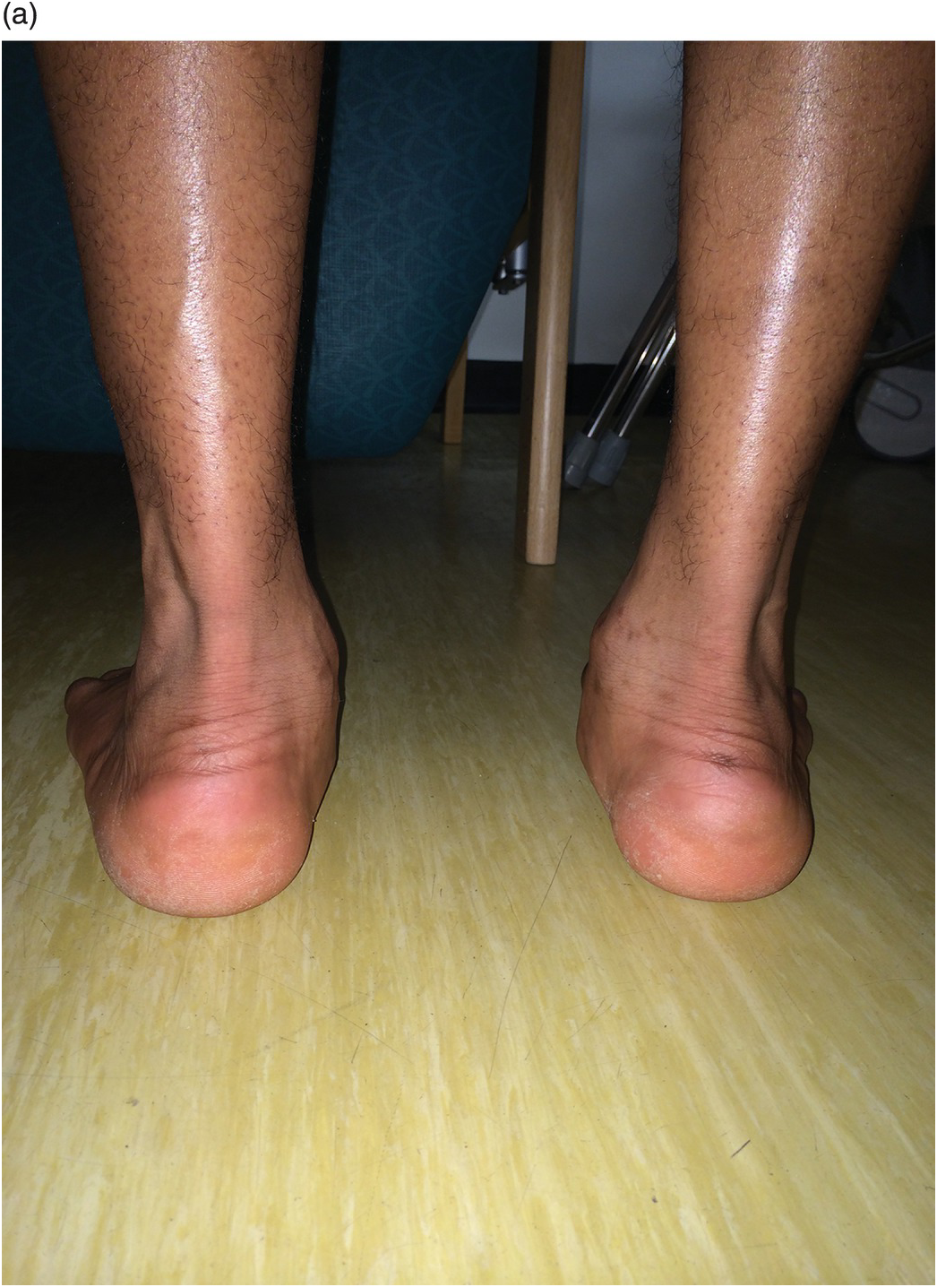 Jack's toe-raising test. An arch is created in a flexible flatfoot