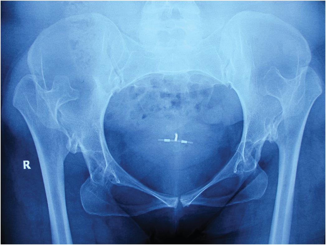 Bilateral central fracture-dislocation of hips after myelography