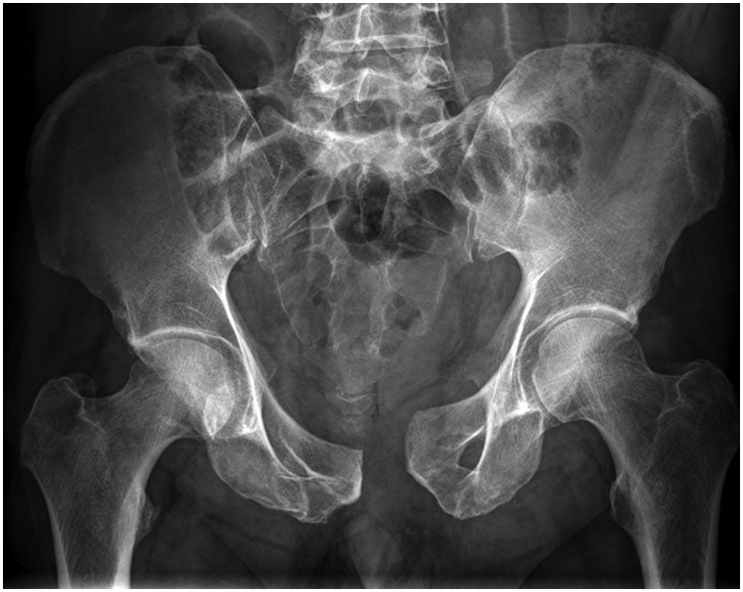Functional outcomes and quality of life at 1-year follow-up after an open  tibia fracture in Malawi: a multicentre, prospective cohort study - The  Lancet Global Health