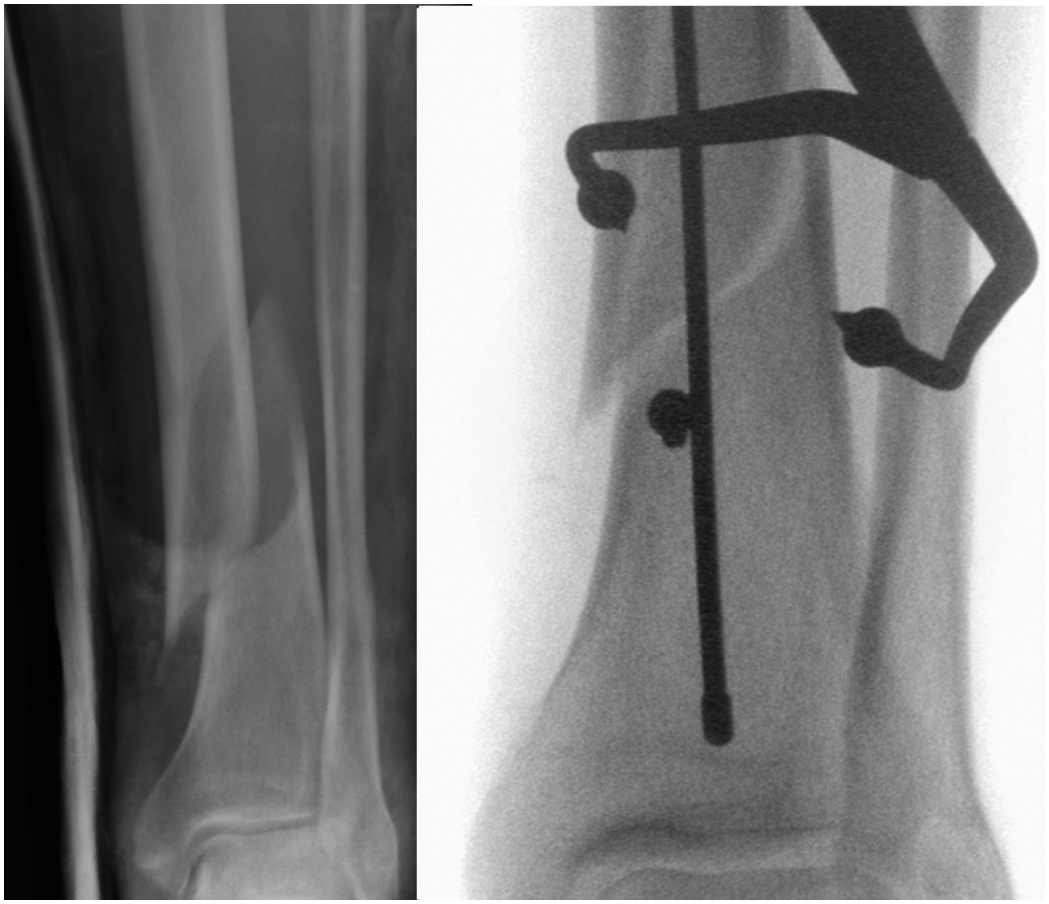 Functional outcomes and quality of life at 1-year follow-up after an open  tibia fracture in Malawi: a multicentre, prospective cohort study - The  Lancet Global Health