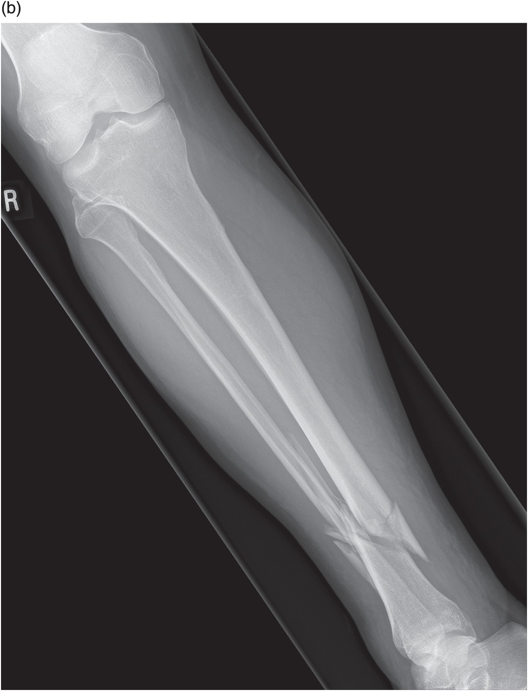 What happpens if the cast is too tight around the proximal portion of the  leg and presses in against the neck of fibula. Where would you predict the  patient would experience tingling