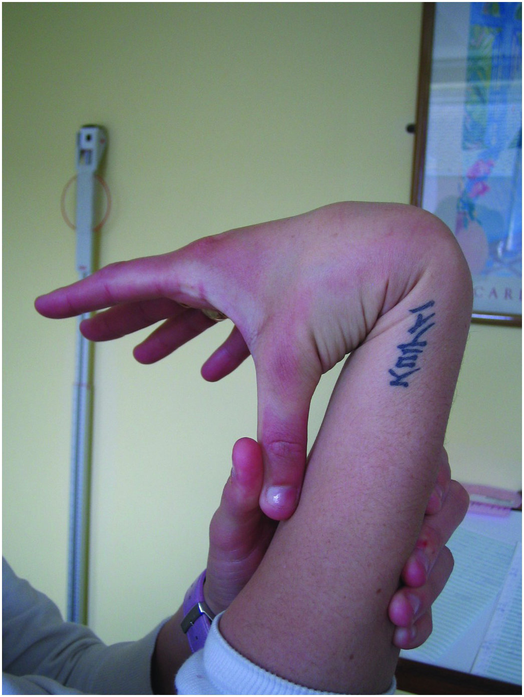 Marfan syndrome hallmarks: claw-shaped hand with long fingers (a